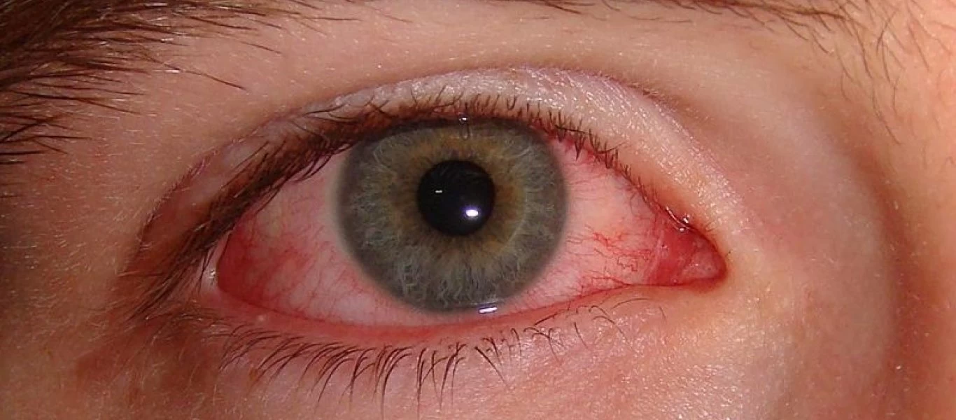 Ξηροφθαλμία: Τι την προκαλεί και πως αντιμετωπίζεται;